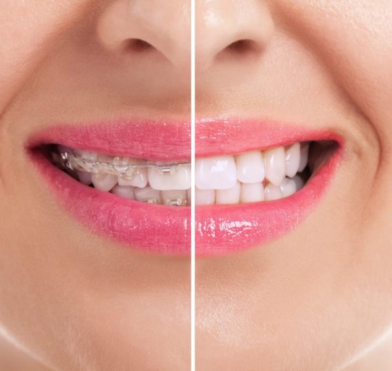 before and after braces