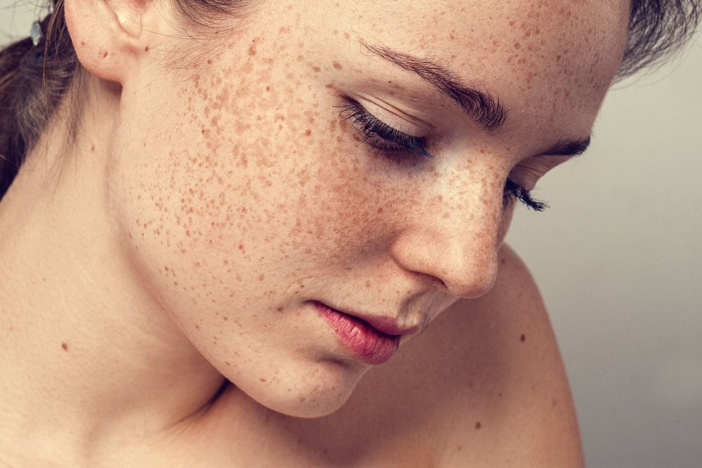Sunspots on Face and Freckles: