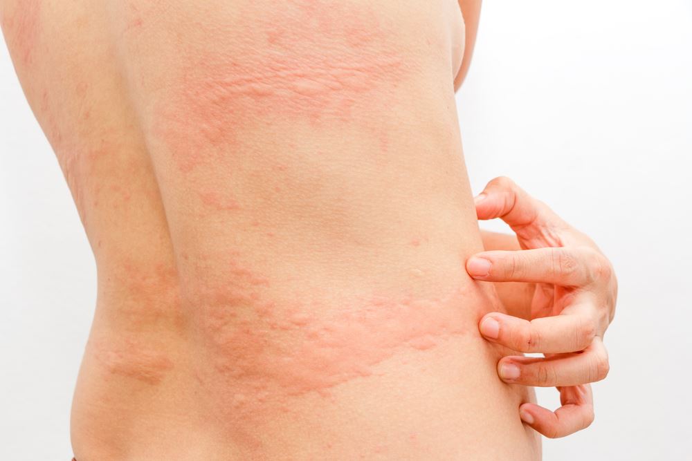 Can You Get Hives In Early Pregnancy