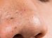 blackheads on nose