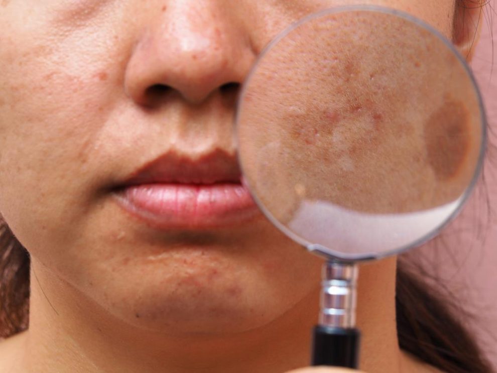 How To Get Rid Of Large Brown Spot On Face