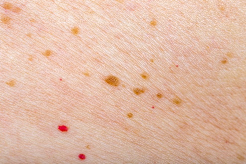 causes-of-small-red-dots-on-skin-and-treatment-charlies-magazines