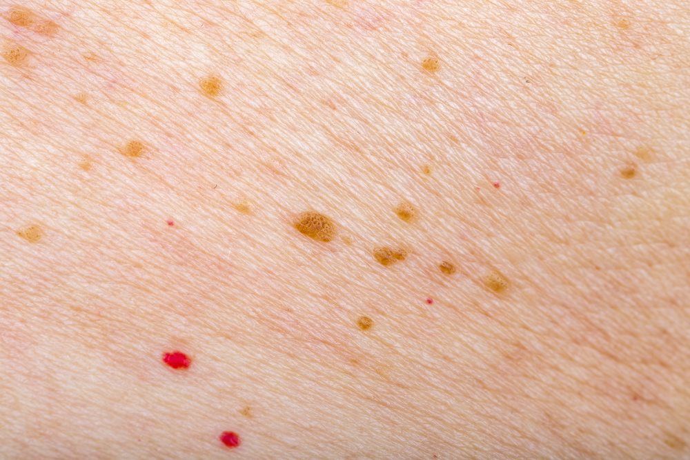 tiny pinpoint red dots on skin caused by viruses