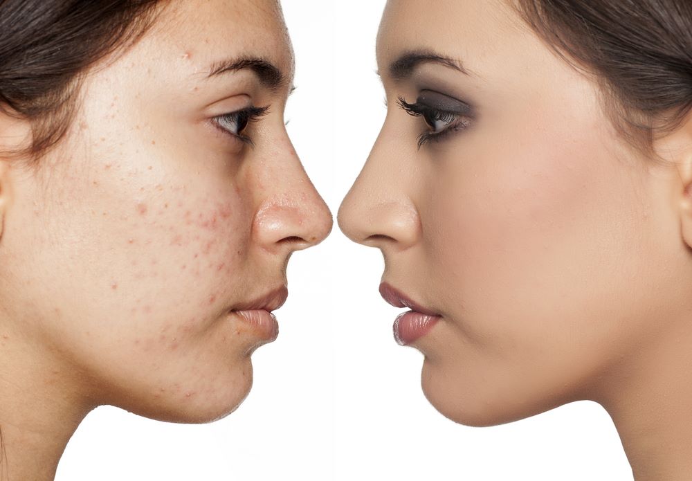 It is a true that picking at pimples causes scars?