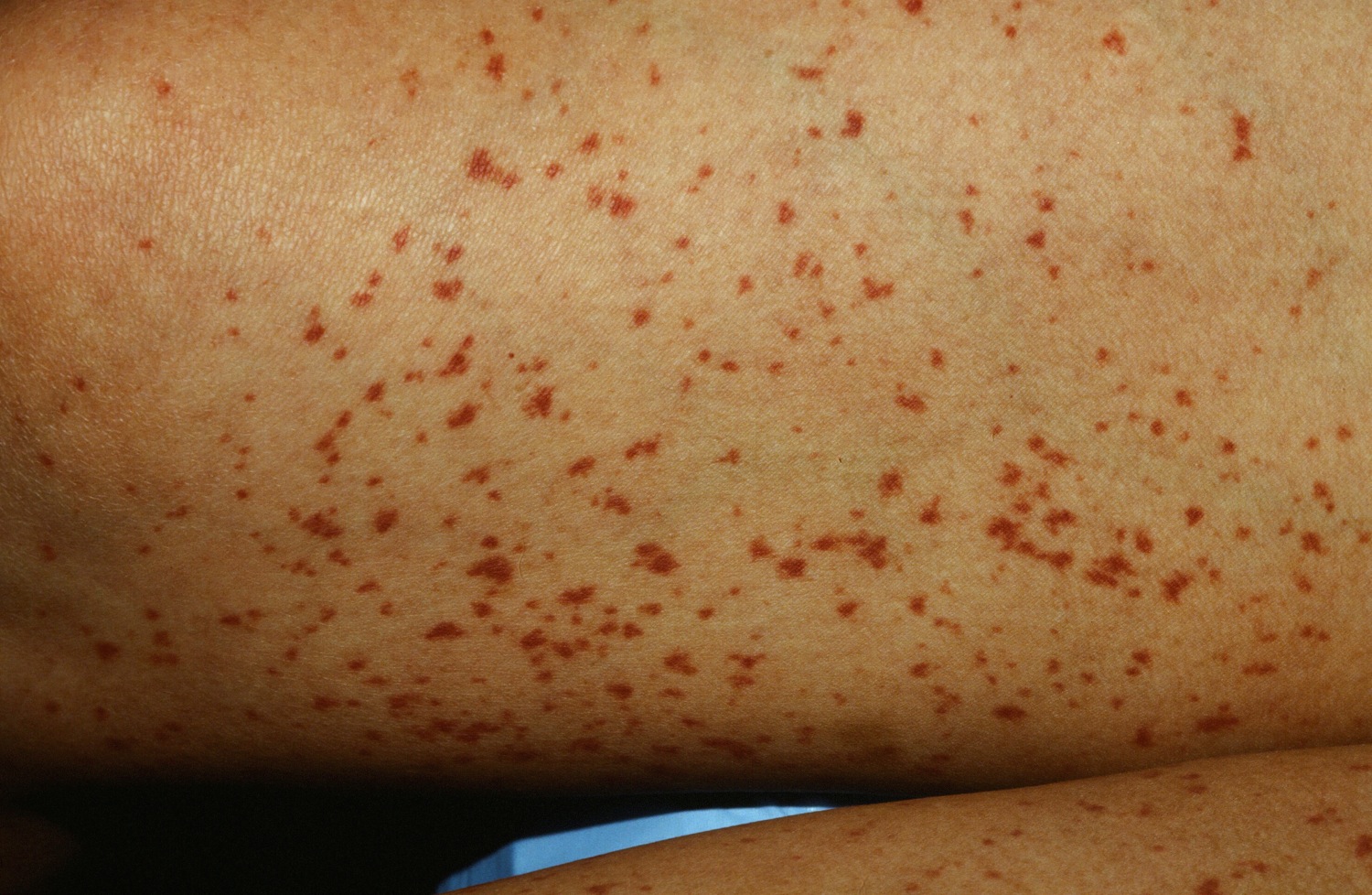 colchicine pinpoint red spots on skin