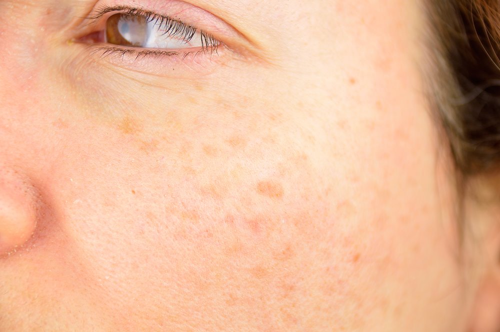 Liver spots