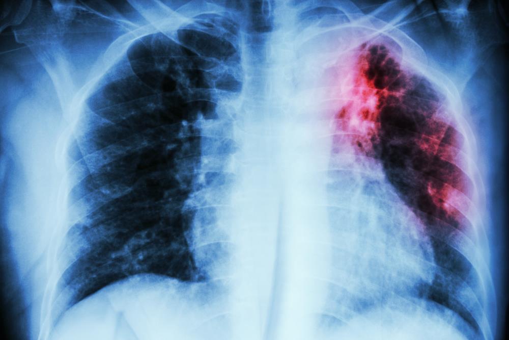 Lung diseases or Pneumonia