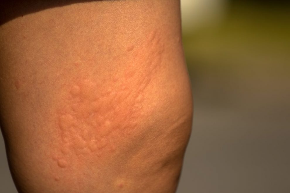 Causes of Rash on Inner Thigh and Treatment - Charlies ...