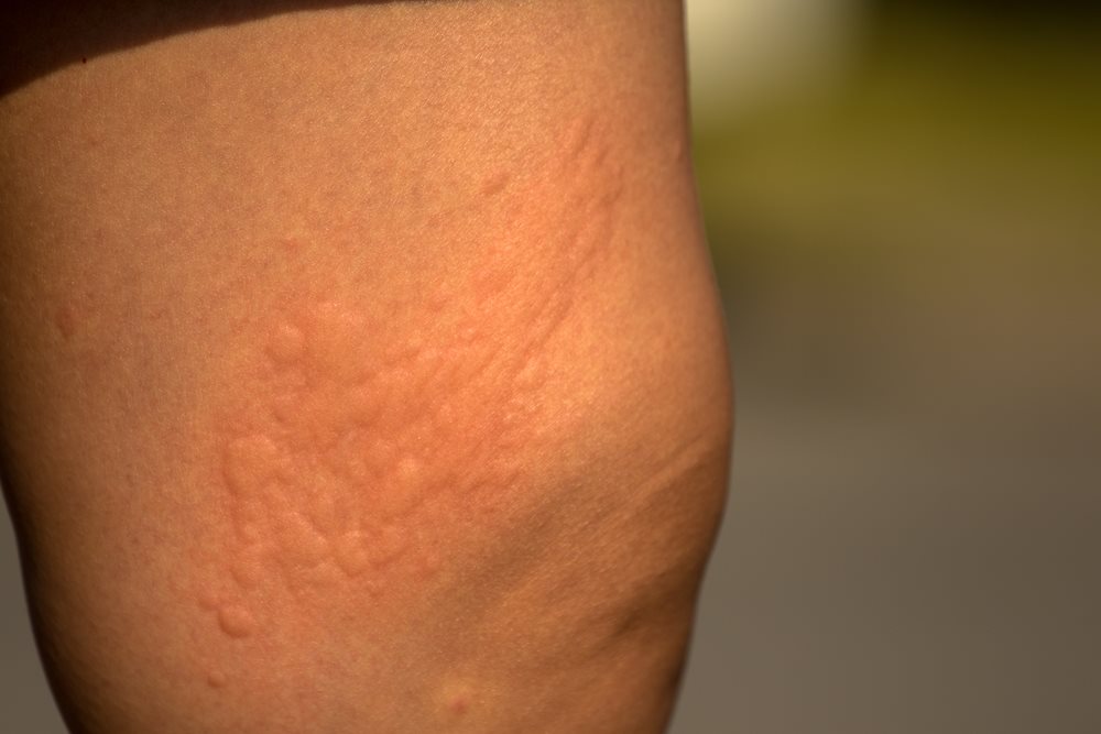 red-spots-on-skin-not-itchy-17-causes-treatments-home-vrogue-co