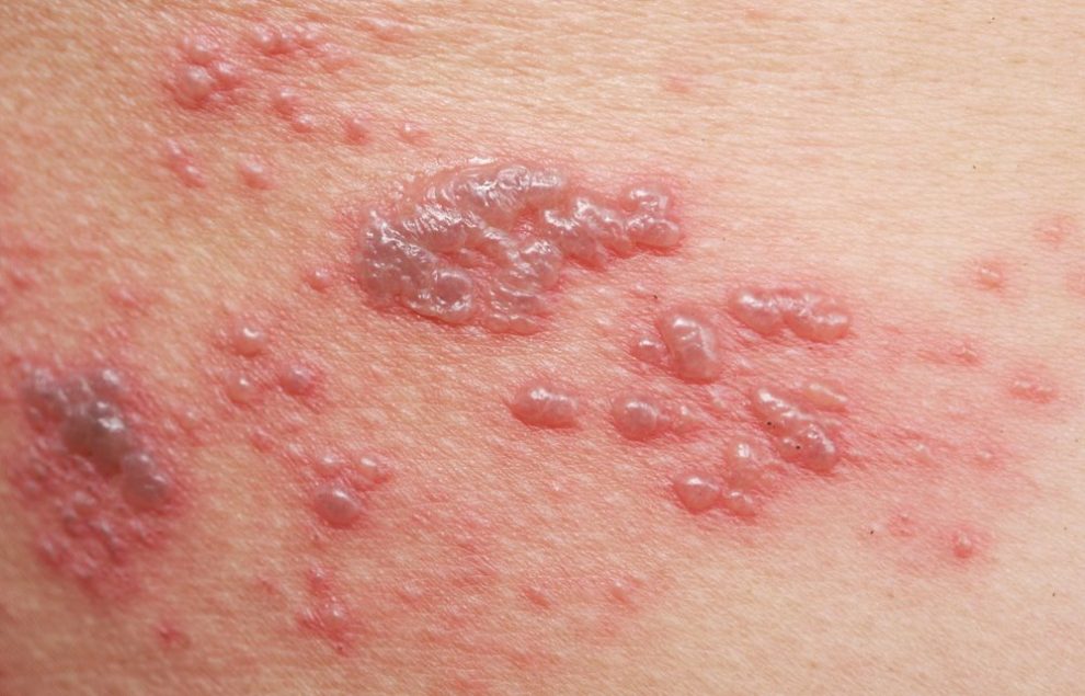 What Causes of Pain under left armpit ? Charlies Magazines