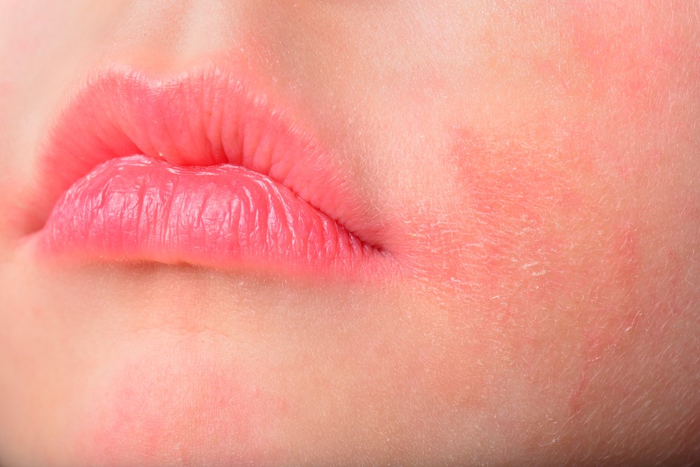 woman with dry patches on her face