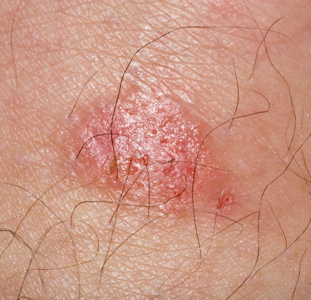 Tinea curis