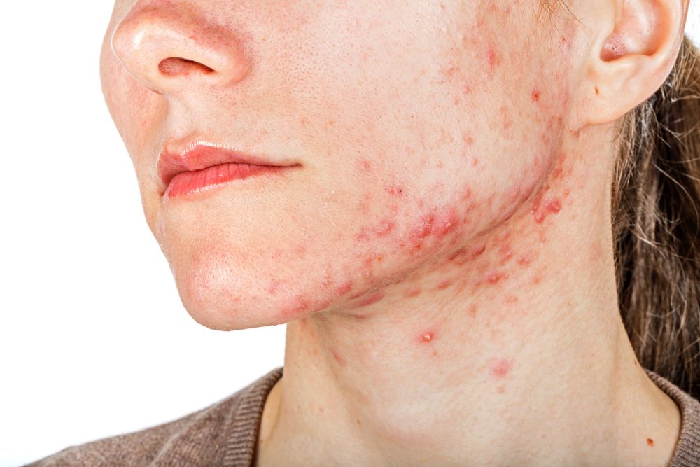 When acne scars are formed?