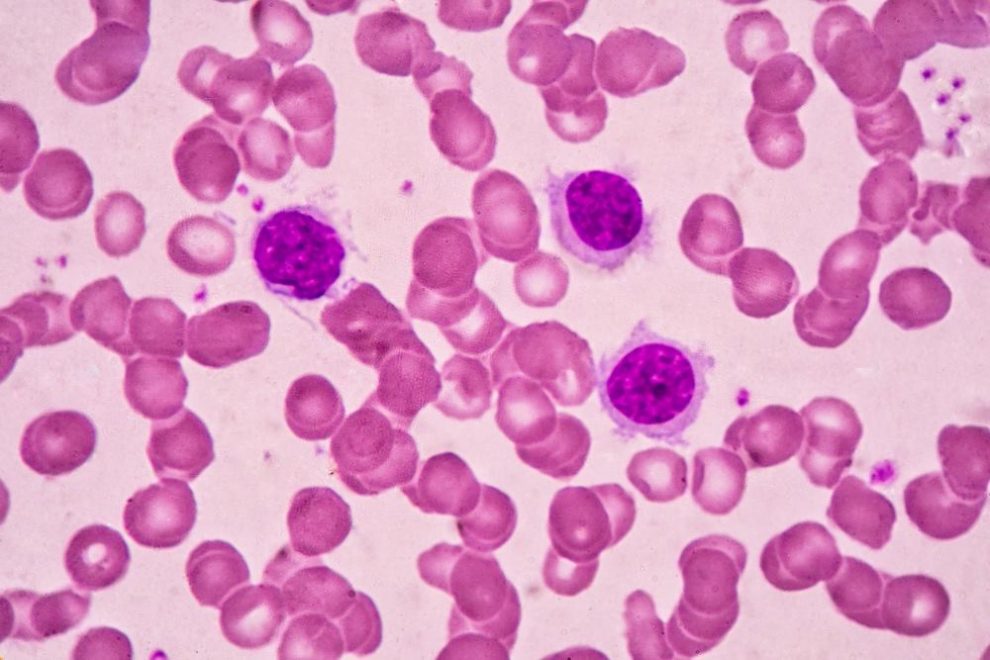 Causes and Treatment of Low Lymphocyte Count [Lymphocytopenia]