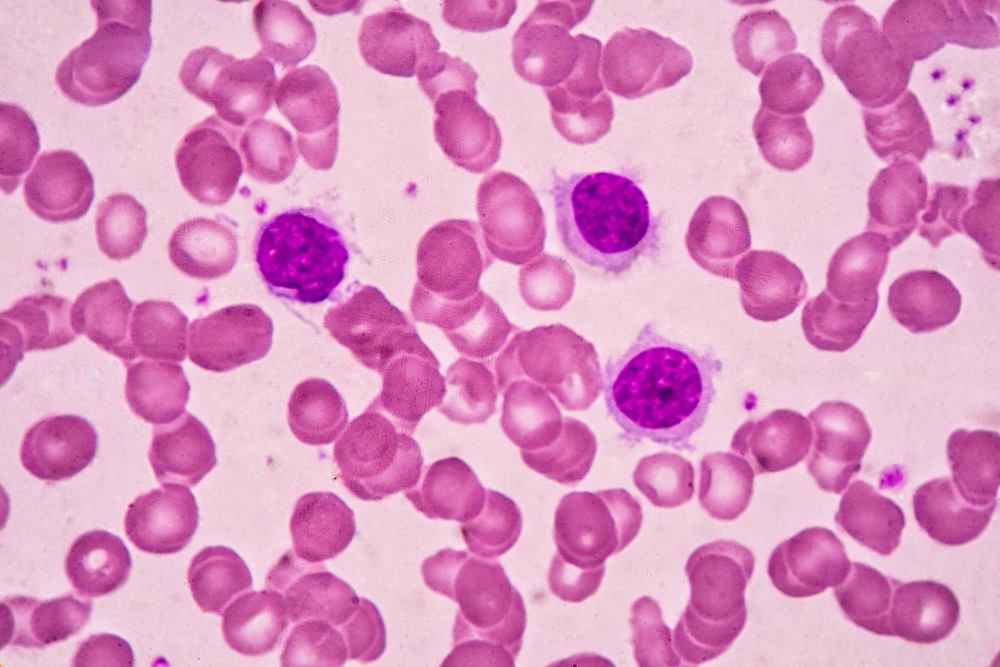 Causes And Treatment Of Low Lymphocyte Count Lymphocytopenia 