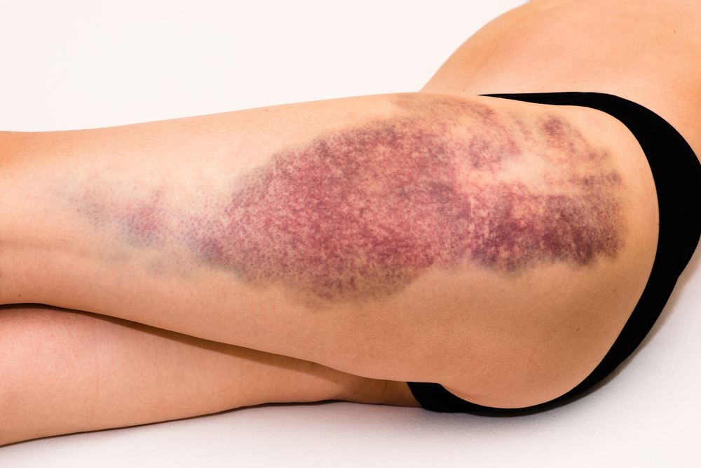 how to get rid of bruises fast 