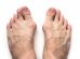 how to get rid of bunions