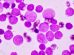 low lymphocyte count