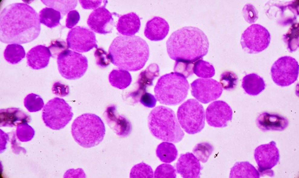 low lymphocyte count