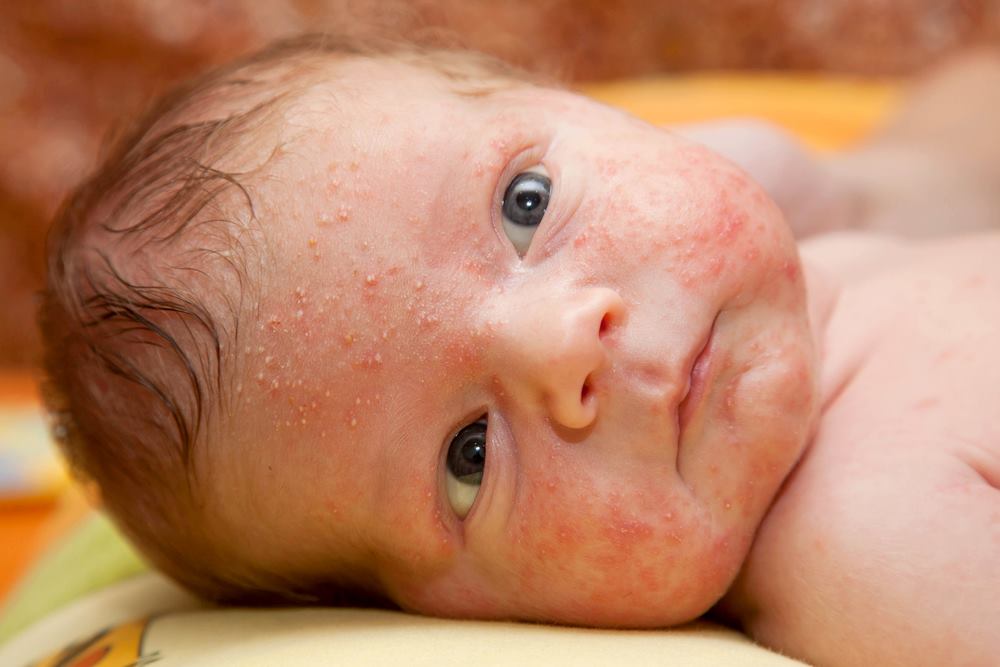 Causes of Baby Acne