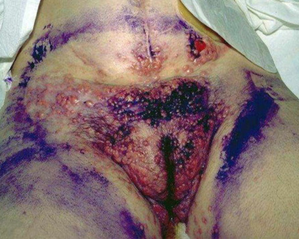 When Disease pic sexual transmitted