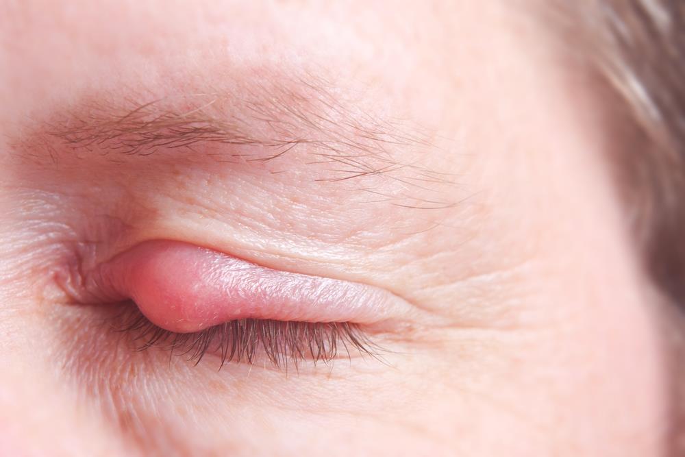 Types of Pimple on the Eyelid