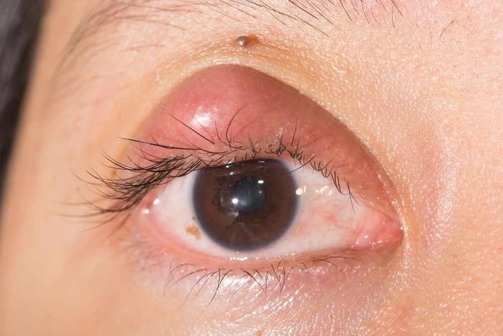 What are the Types of Stye