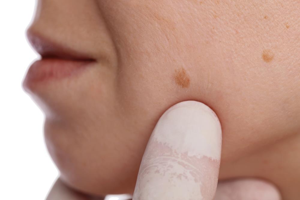 Which Parts of Skin are more prone to develop Skin Tags ?