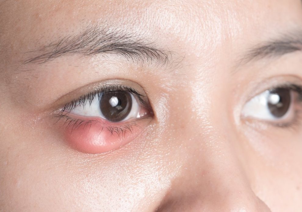 10 Natural Remedies To Get Rid Of Stye Fast Charlies Magazines