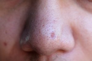 large pores on nose