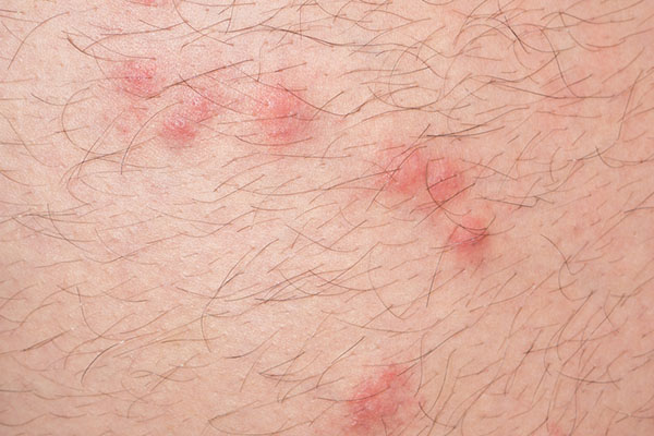 Symptoms of chigger bites