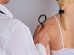 skin tag removal