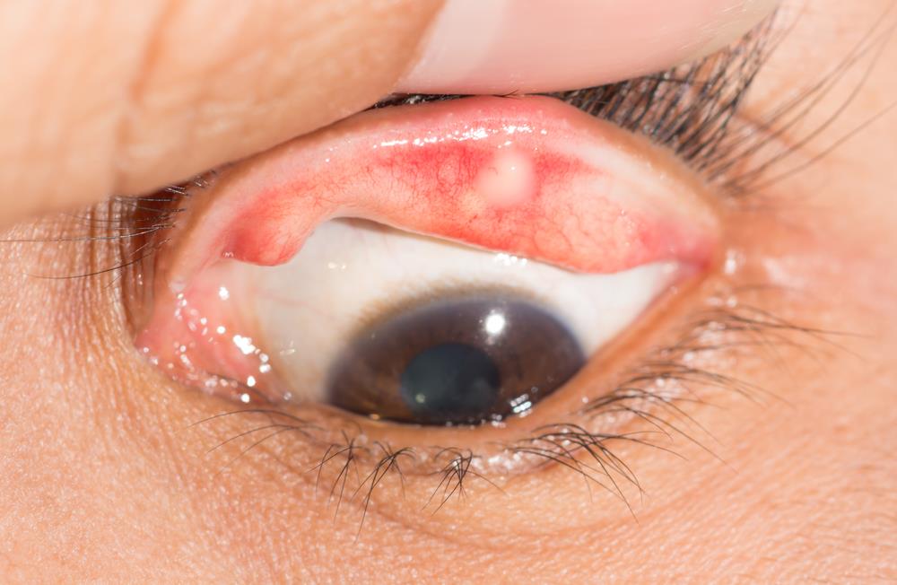 Symptoms of Stye