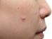 whiteheads on face