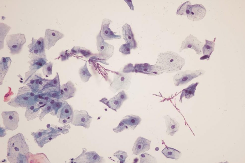 7 Home Remedies for Jock Itch in Women Charlies Magazines