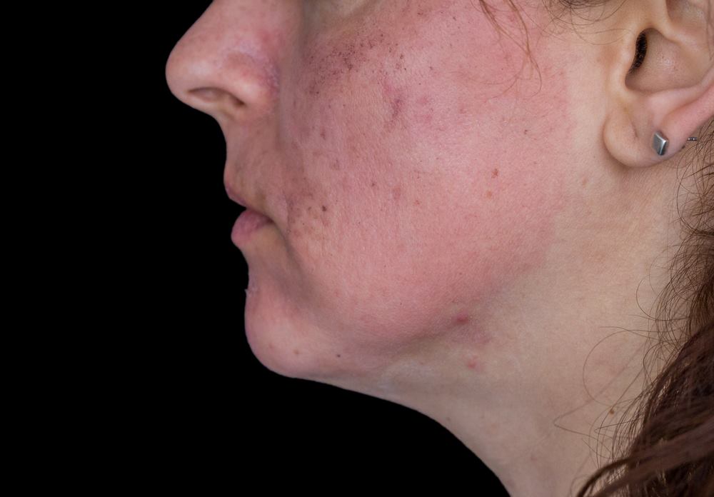 What Causes Black Spot On Face