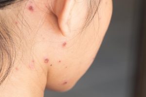chicken pox scars