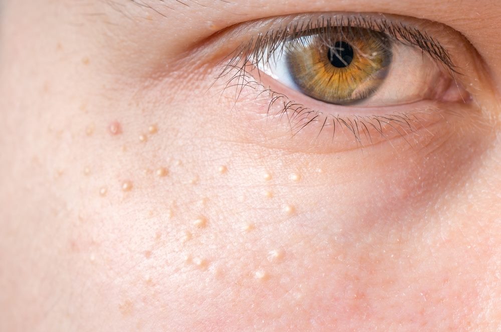 Causes of Blind pimples Under the Skin
