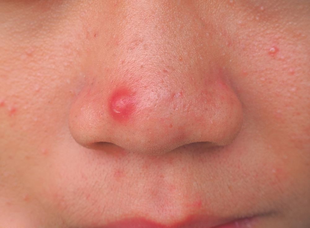 Causes of Pimple in Nose