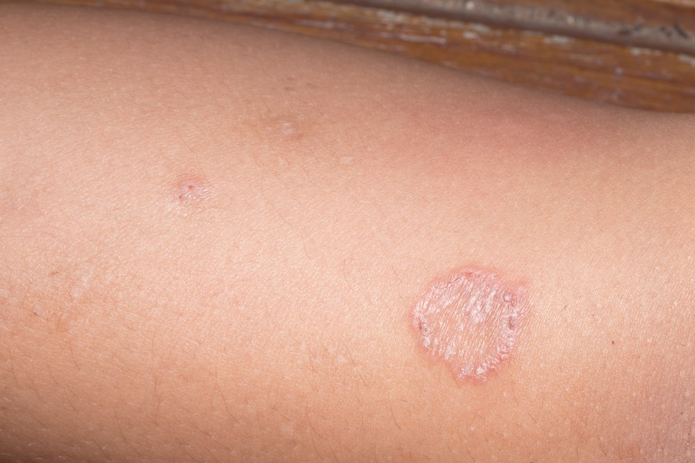 Causes of ringworm infection