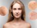 how to get rid of zits