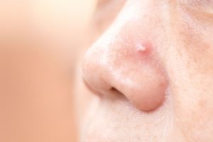 pimple in nose