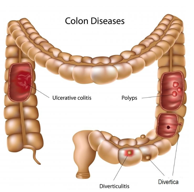 Excessive Gas And Mucus In Stool