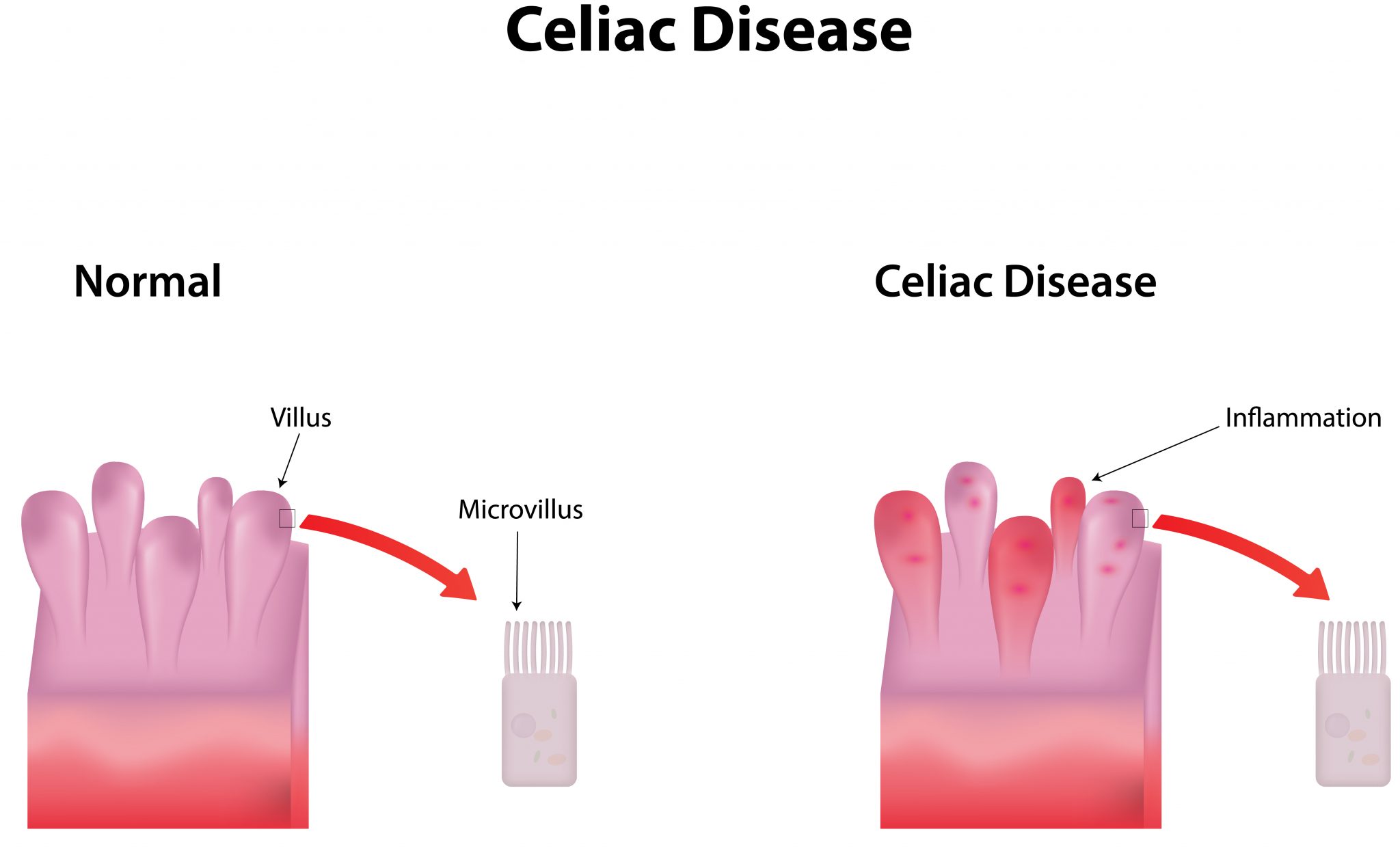 Steatorrhea Causes