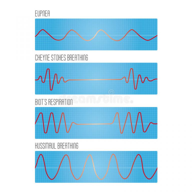 Causes and Treatment of Kussmaul Breathing Charlies Magazines