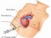 cardiac tamponade