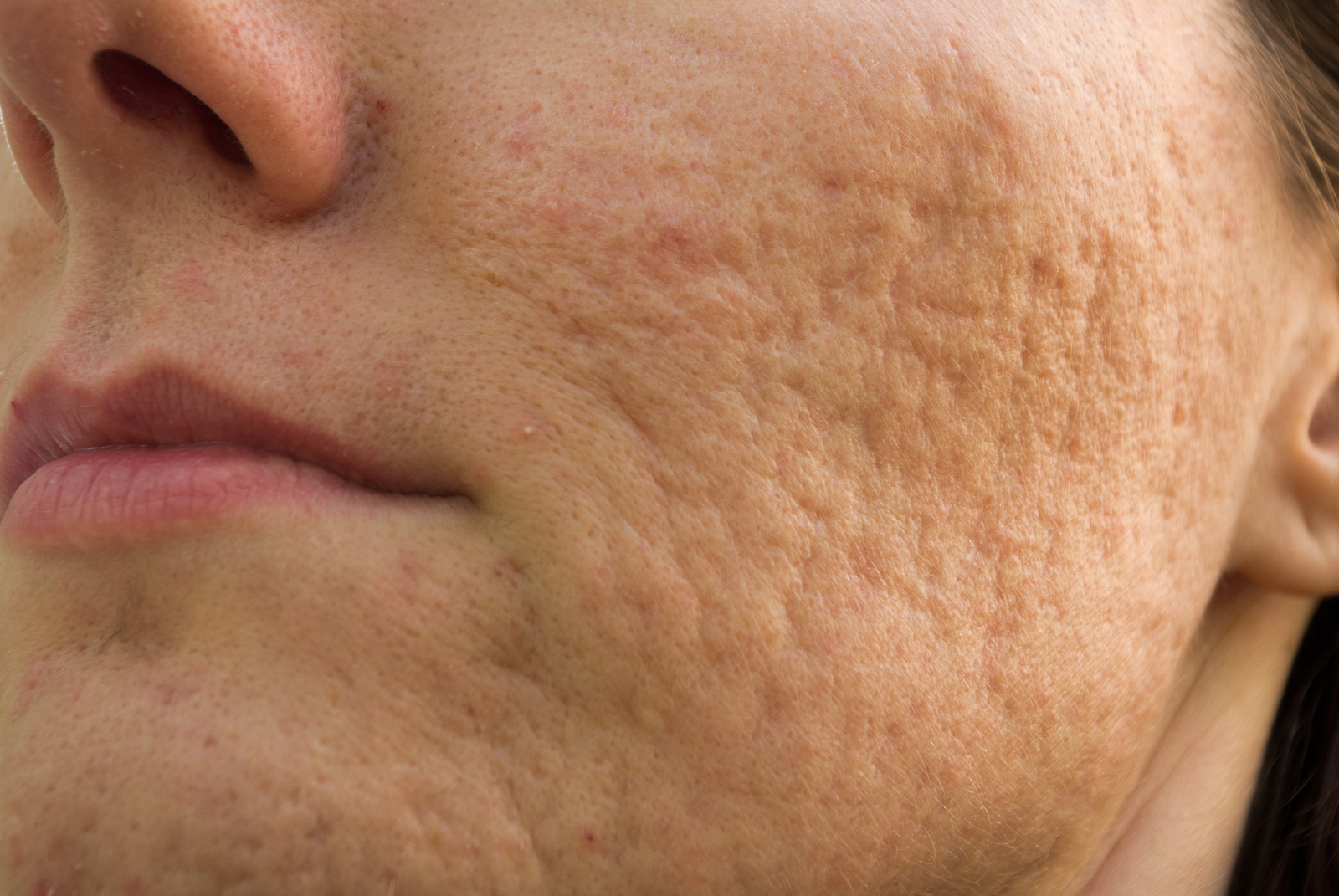 Types of Acne And Causes