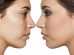 Types of Acne.